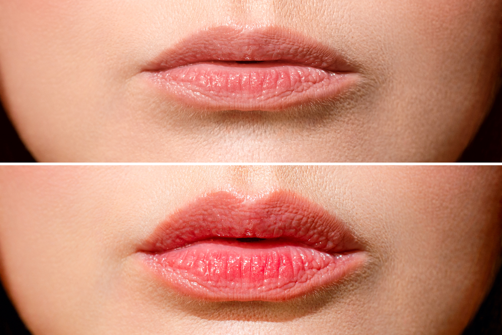 Result before and after lip filler